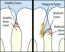 Periodontitits