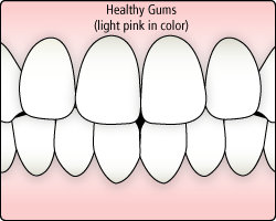 illustration showing healthy gums